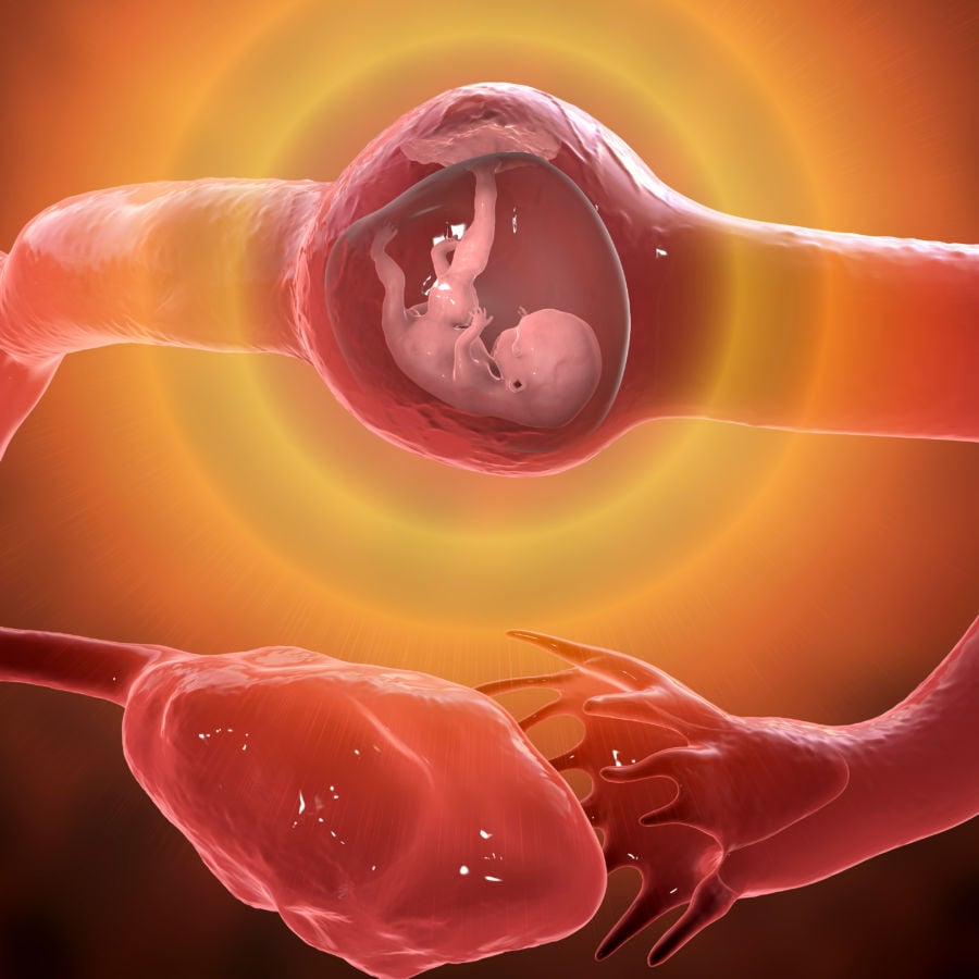 Ectopic Pregnancy